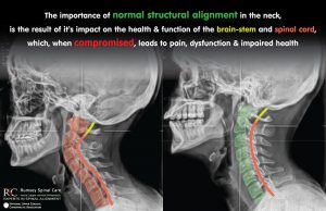 picture showing the importance of upper cervical chiropractic alignment of the atlas